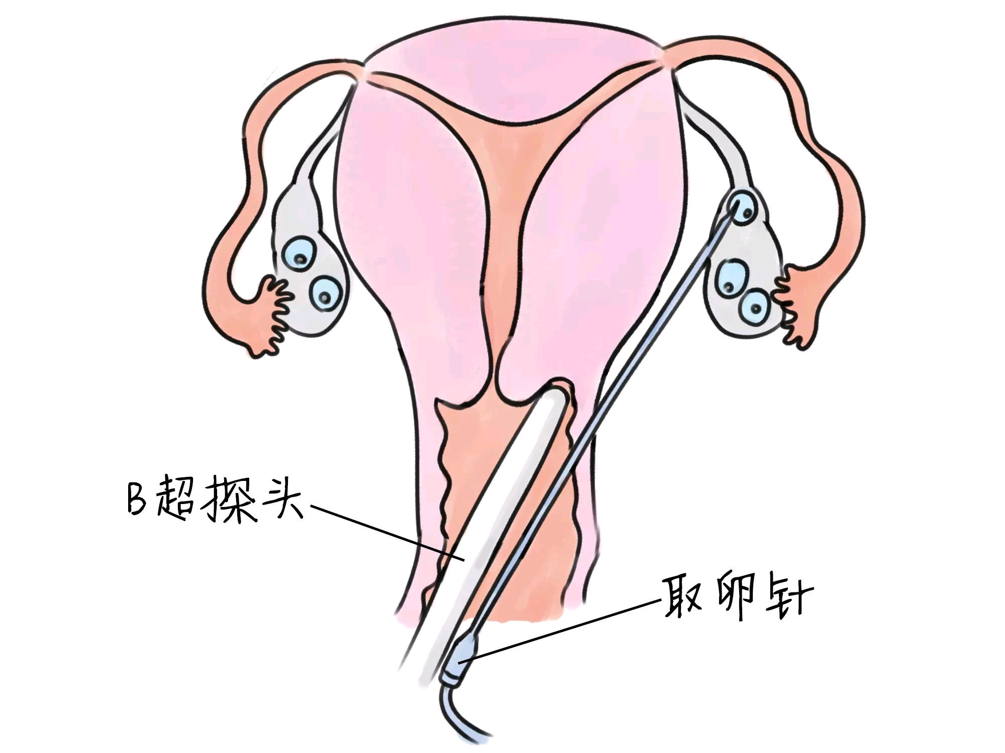 农村怀孕顺产分娩