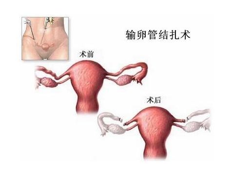 人流术后饮食