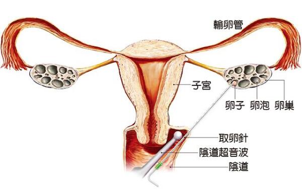 重庆人工助孕